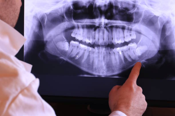 Best Emergency Dentist for Lost Fillings or Crowns in Perryville, MD